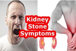 What are Kidney Stones and How to avoid them