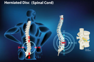 physiotherapy for slip disc