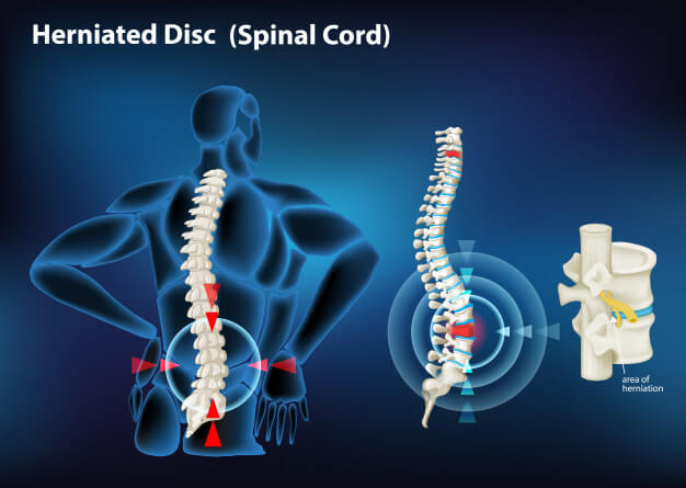 physiotherapy for slip disc