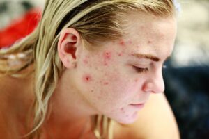 Laser For Acne Scars