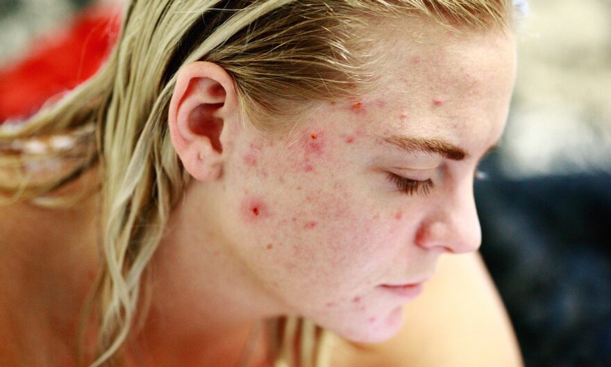 Laser For Acne Scars