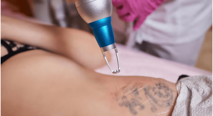 Laser Tattoo Removal