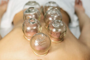 TCM Cupping