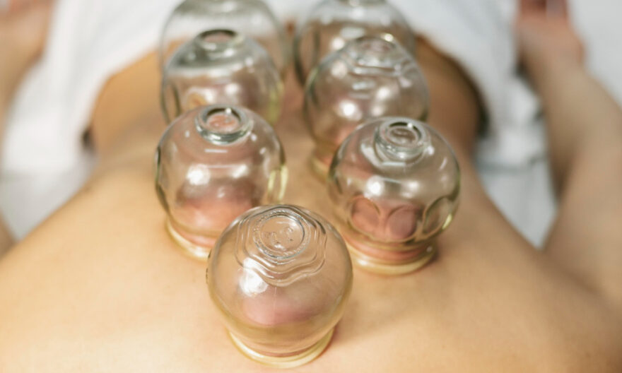 TCM Cupping