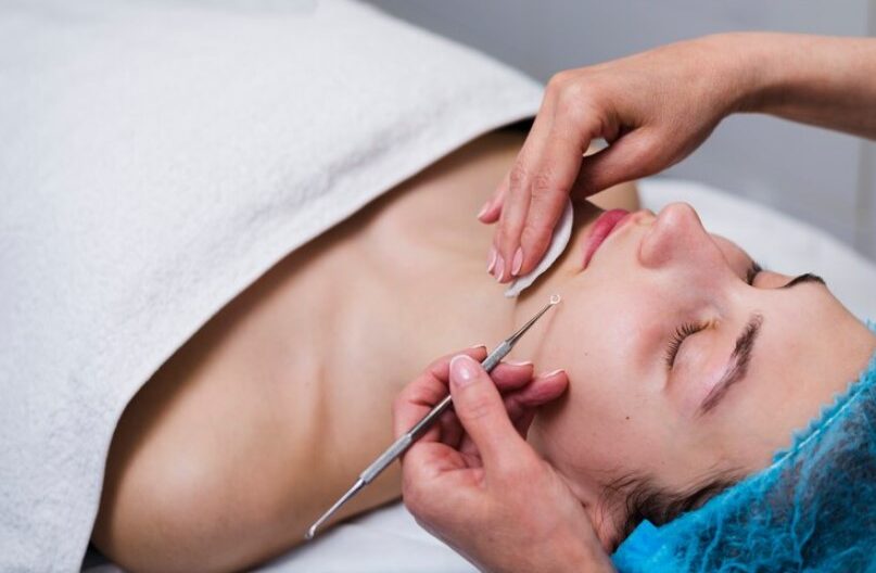 ice pick scars treatment Singapore