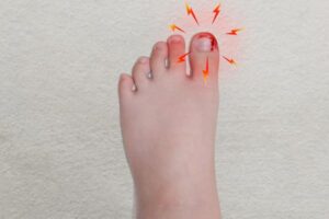 ingrown toenail clinic