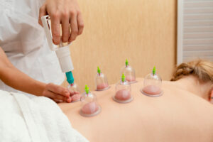 Cupping Therapy For Health Improvement