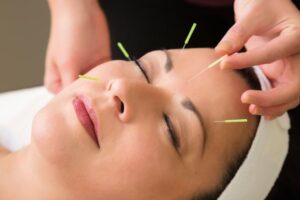 facial acupuncture