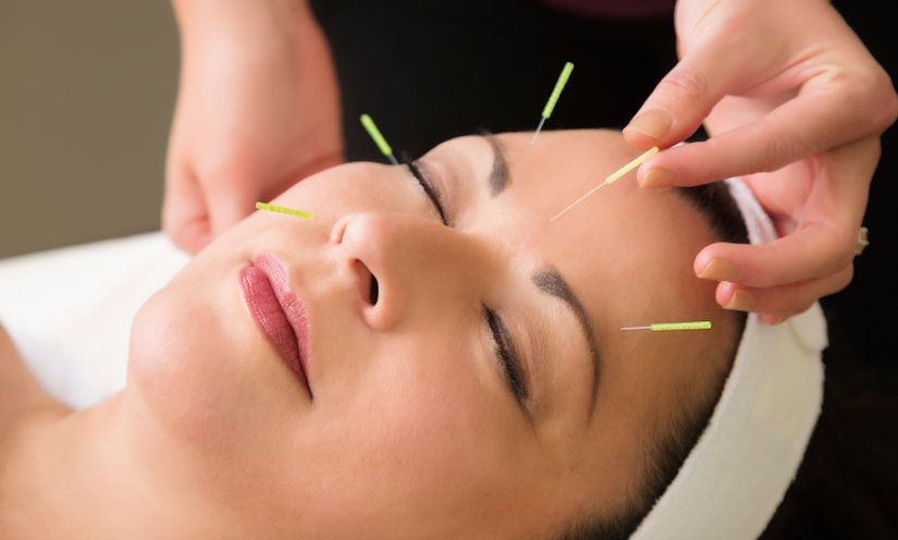 facial acupuncture