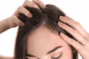 dandruff treatment