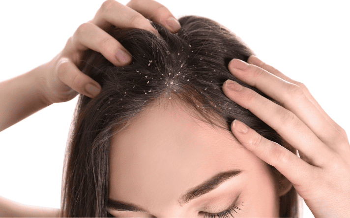 dandruff treatment