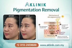 pigmentation removal