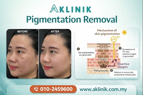 pigmentation removal