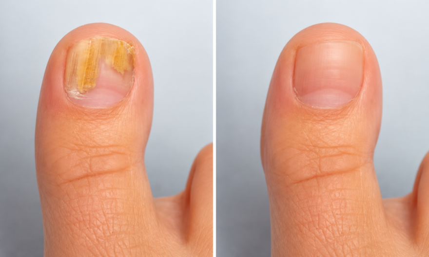 nail fungus treatment